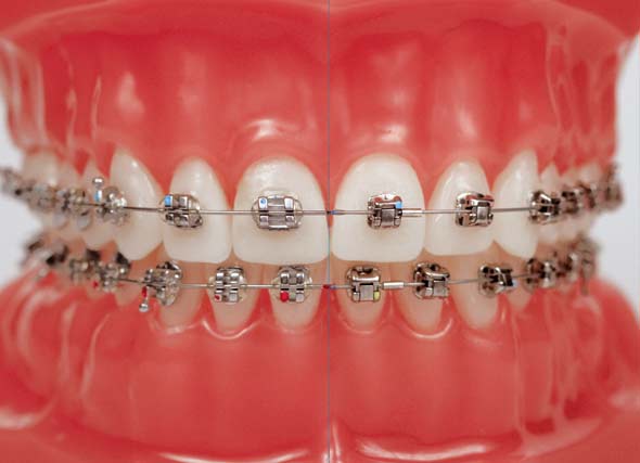 ارتودنسي ديمون