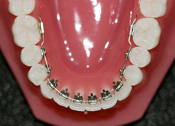 ارتودنسی لینگوال