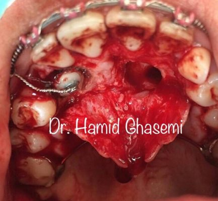 هدايت دندان نهفته به روش ارتودنسي