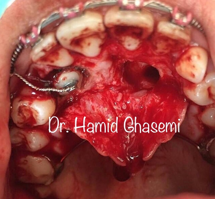 هدايت دندان نهفته به روش ارتودنسي