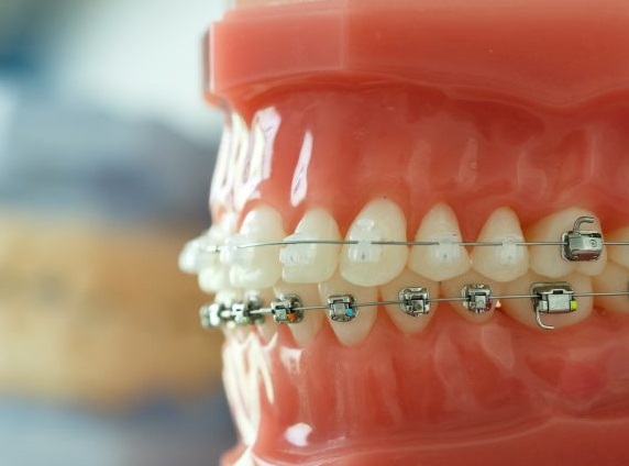 عوارض ارتودنسی دندان