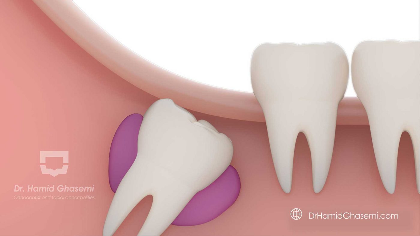 رابطه دندان عقل و بهم ریختگی دندانی