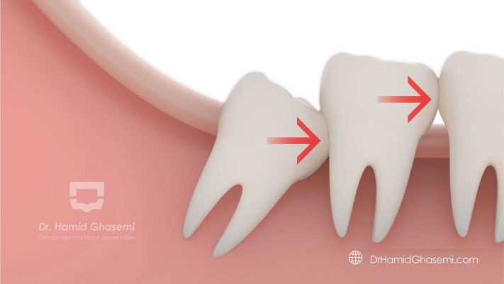 رابطه دندان عقل و بهم ریختگی دندانی