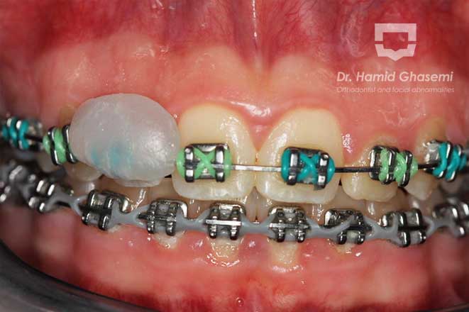 نحوه استفاده از موم ارتودنسی