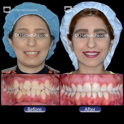 ارتودنسی جلوزدگی فک