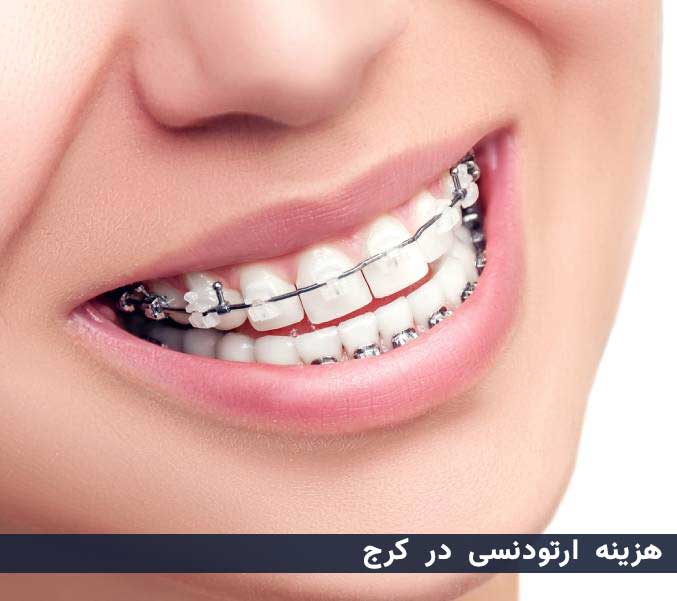 هزینه ارتودنسی در کرج